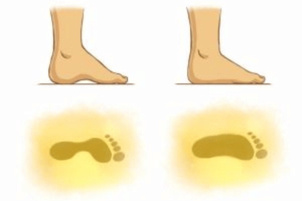 Telapak Kaki Datar (Flat Feet)