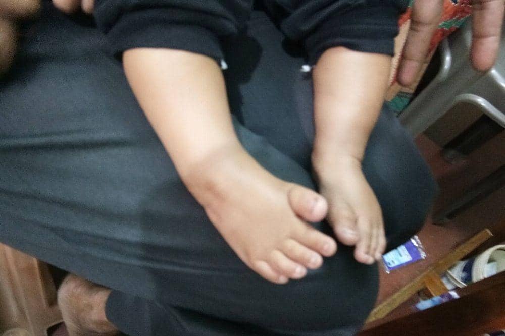 Apakah Kaki Bayi CTEV Bisa Disembuhkan? Ini Penjelasannya