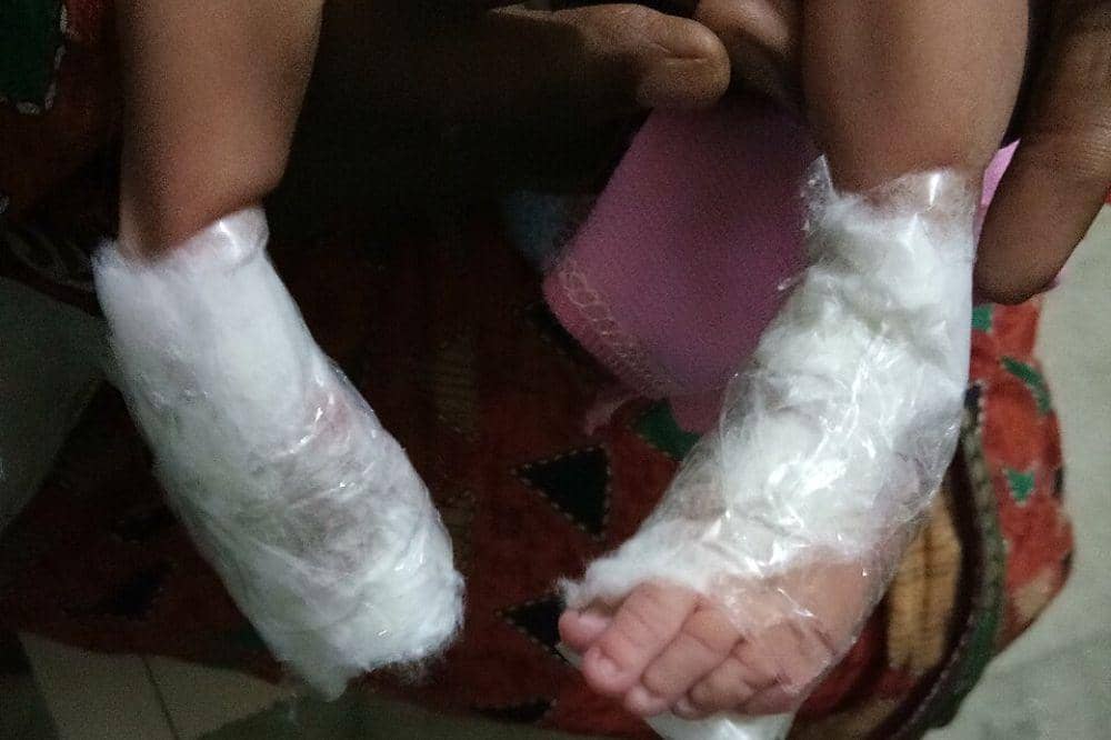 Apakah Kaki Bayi yang Terkena CTEV Bisa Disembuhkan?