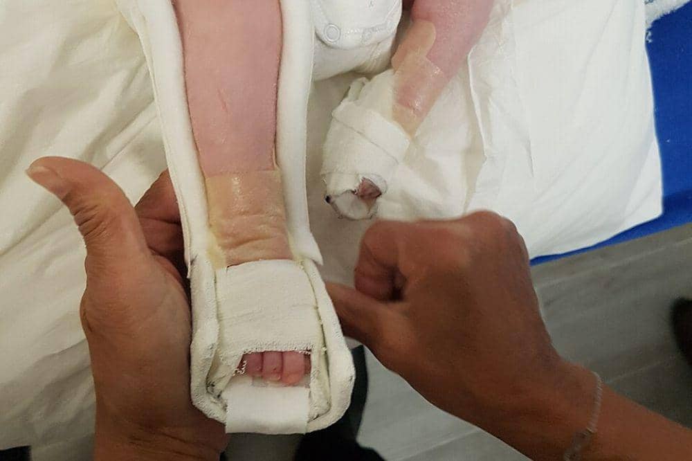 Bagaimana Cara Mengobati Kaki Bayi yang Terkena CTEV?