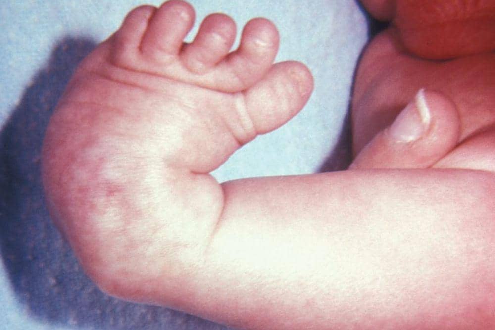 Bagaimana Cara Merawat Bayi selama Pengobatan CTEV?