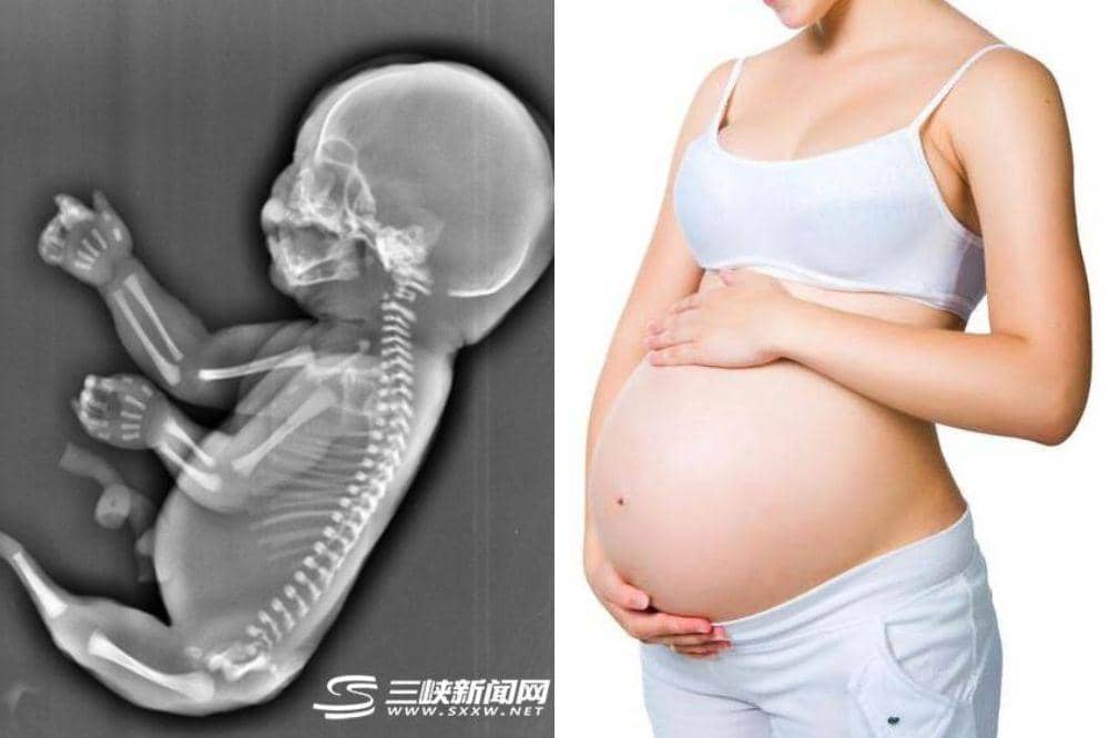 Ibu Hamil Gugurkan Bayi 6 Bulan karena Mermaid Syndrome