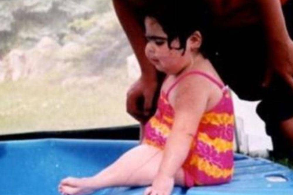 Penyebab pasti mermaid syndrome masih belum diketahui