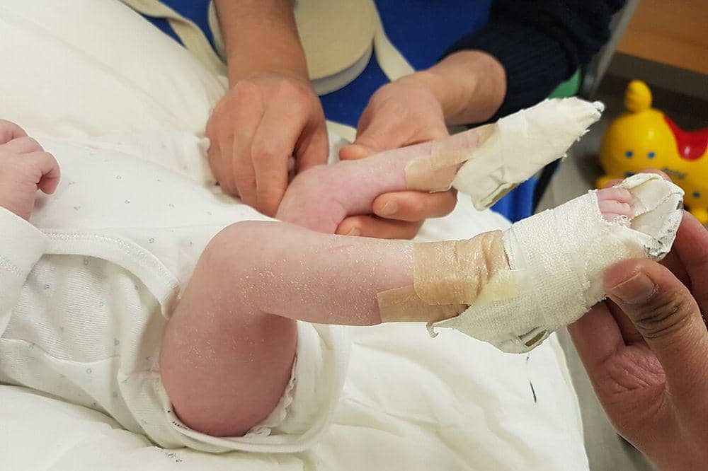 Kapan Pengobatan CTEV pada Bayi Sebaiknya Dimulai?