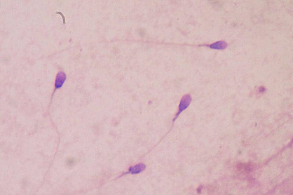 Kegagalan pembentukan testis akibat kelainan genetik