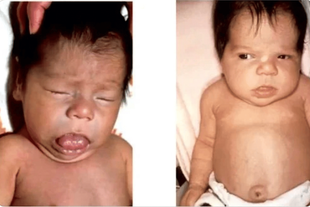 Apa Itu Kretinisme pada Bayi? Kenali Tanda-tandanya Sejak Dini