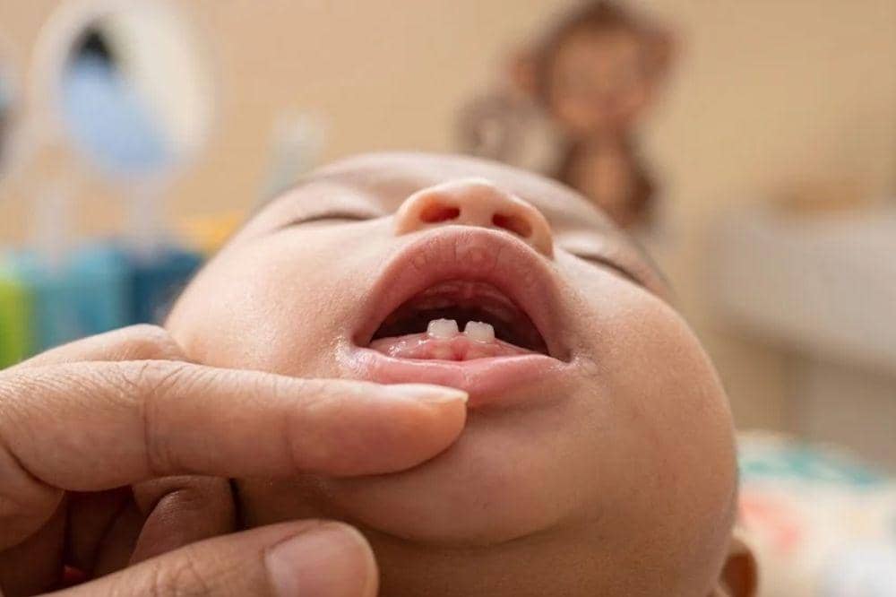 Fluoride membantu mencegah karies sejak gigi pertama tumbuh